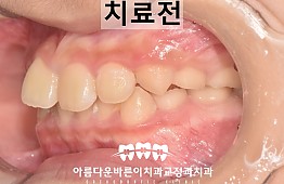 수술전