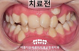 수술전