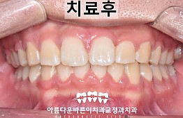 수술후