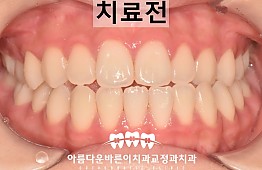 수술전
