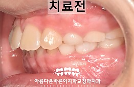 수술전