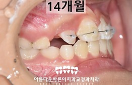 수술후