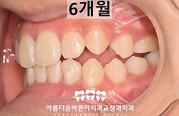 수술후