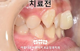 수술전