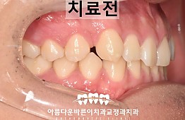 수술전