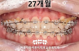 수술후