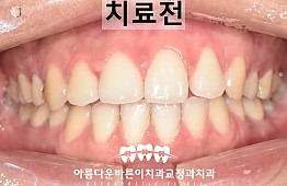 수술전