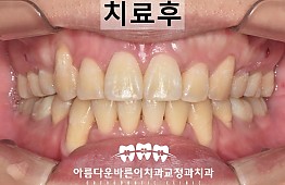 수술후