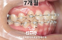 수술후