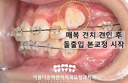 수술후