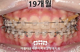 수술후