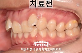 수술전