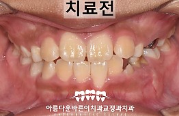 수술전