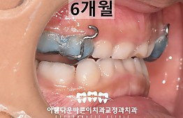 수술후