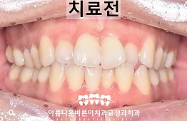 수술전