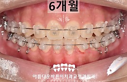 수술후