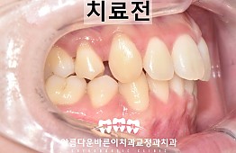 수술전