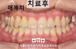 수술후