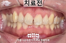 수술전