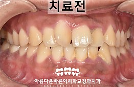 수술전