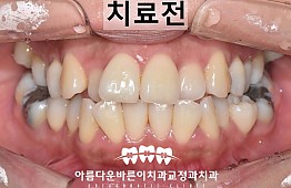 수술전