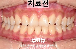 수술전