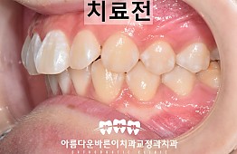 수술전