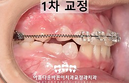 수술후