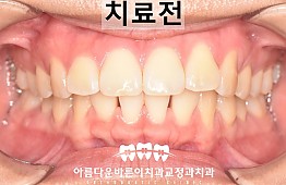 수술전