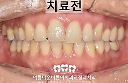 수술전
