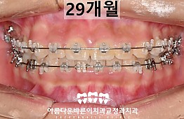 수술후