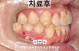 수술후