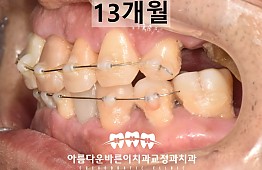 수술후