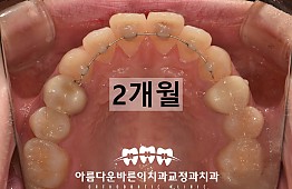 수술전