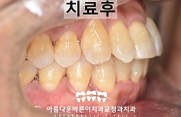 수술후