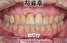 수술후