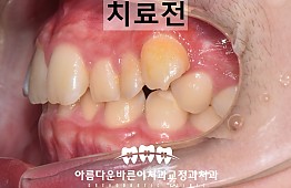 수술전