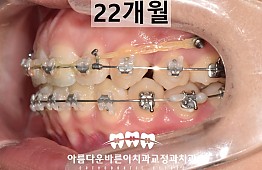 수술후