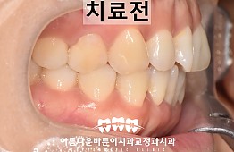 수술전