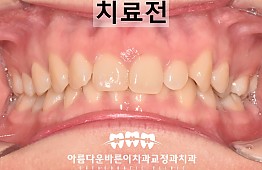 수술전