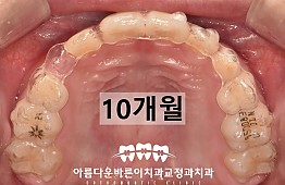 수술후