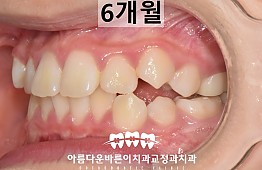 수술후