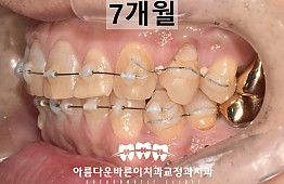 수술후