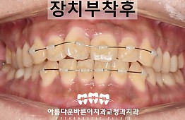 수술후