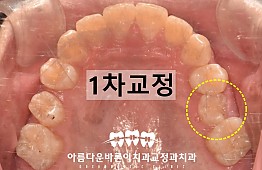 수술후