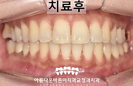 수술후