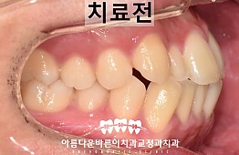 수술전