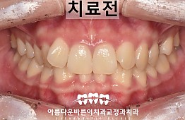 수술전