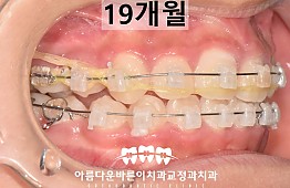 수술후