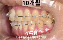 수술후